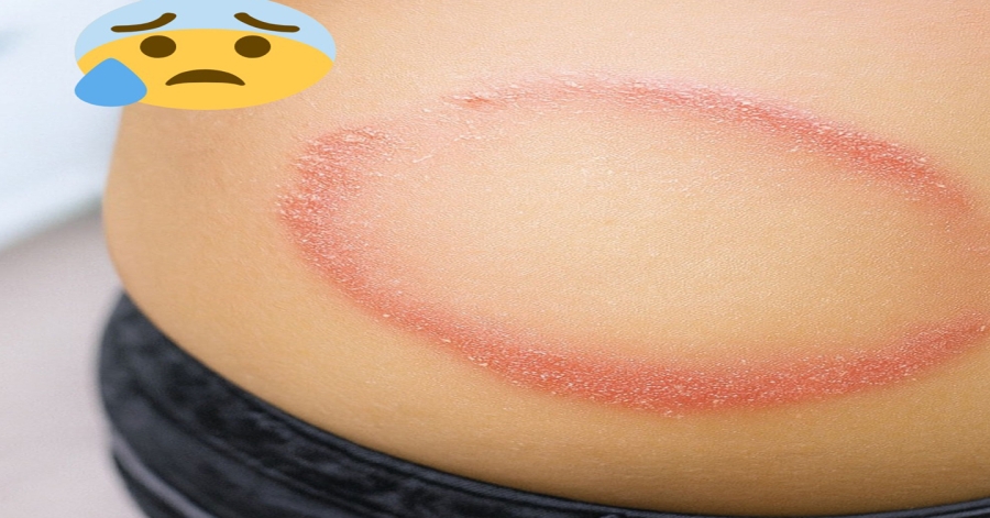 How to identify and cure skin fungus 