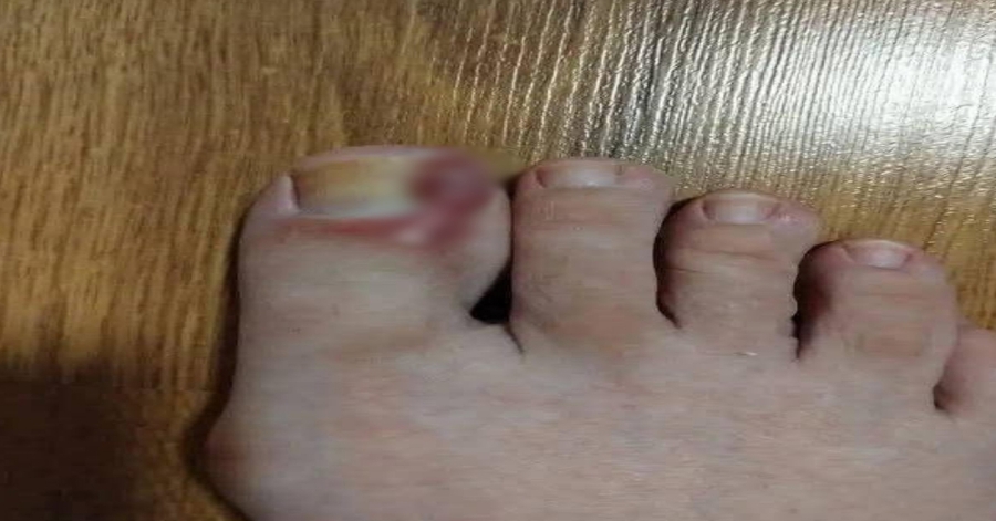 How to Treat an Ingrown Toenail at Home