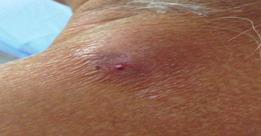 He Thought He Had Acne, But It Was Something Completely Different