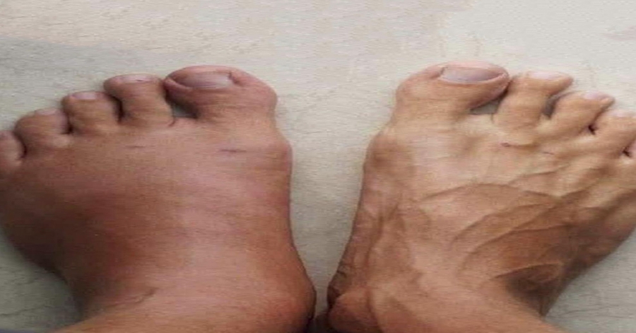 Swollen feet: a sign you shouldn’t ignore