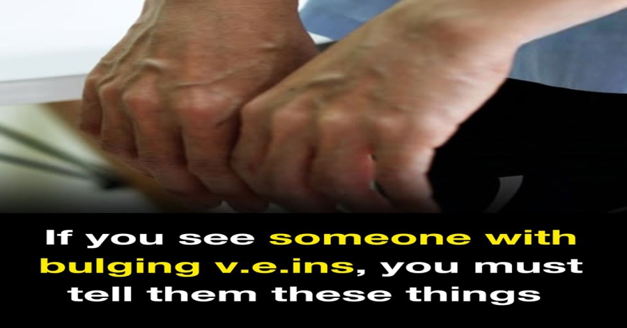 7 Daily Habits That Make Your Veins Bulge More