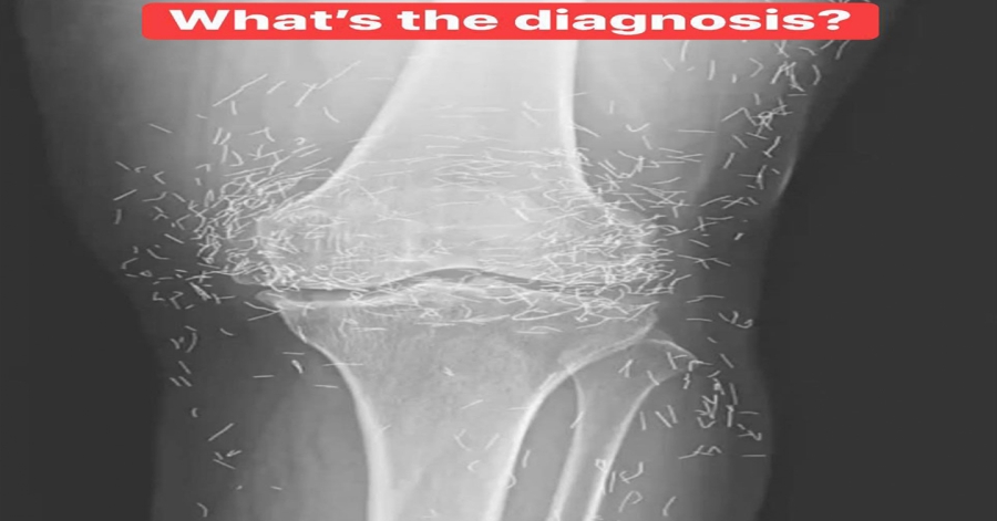 X-Ray Reveals Hundreds of Gold Needles in Woman’s Knees