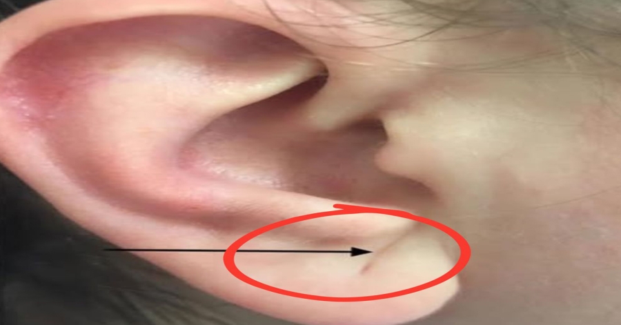 If this sign appears in your ear, it is a war:ning sign that you have ca…