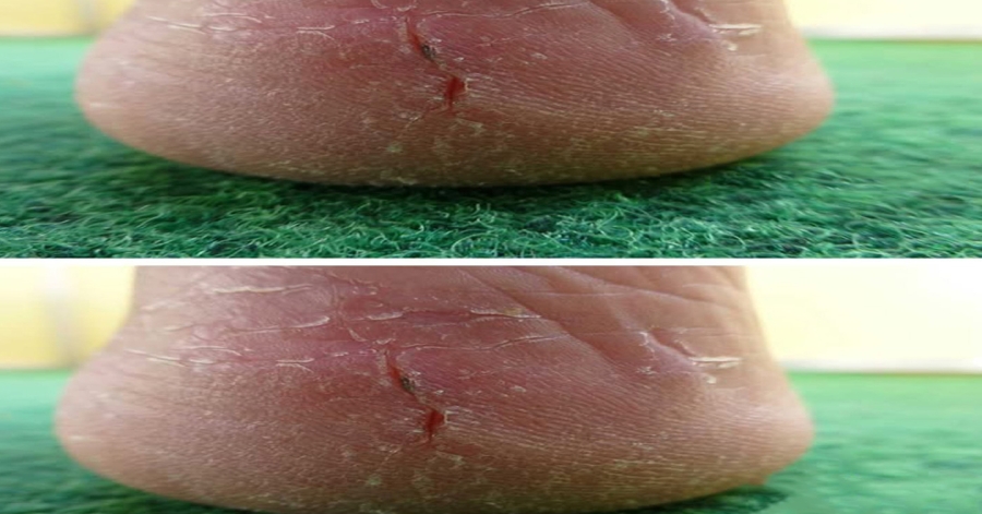 My heels are splitting open