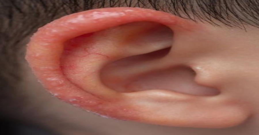 I noticed a strange patch of skin on my son’s ear this morning