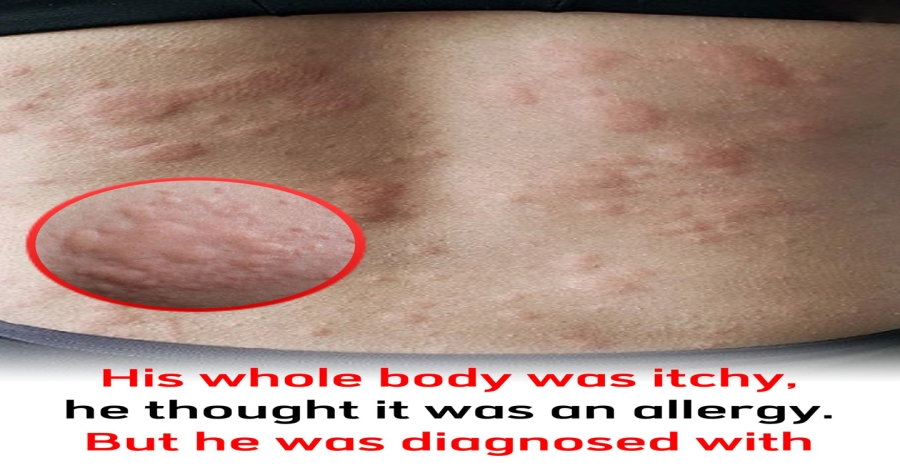 His whole body was itchy, he thought it was an allergy and was diagnosed